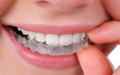 5 Reasons I’m Glad I Chose Invisalign