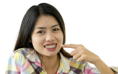 Five Great Things About Self-Ligating Braces