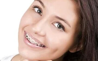 Why is Flossing So Important When I Have Braces?
