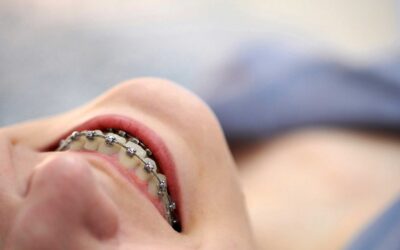 Getting Your Best Smile With Damon Braces