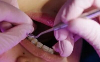 When Is A Good Age For Braces?