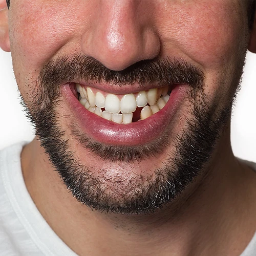 Missing Lateral Incisors