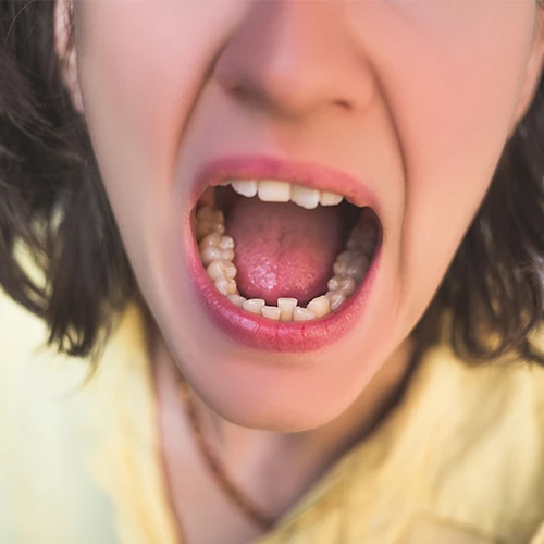 Teeth Crowding