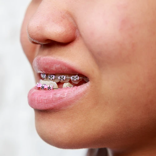 Underbite