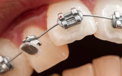How do you handle orthodontic emergencies such as broken braces or lost retainers?