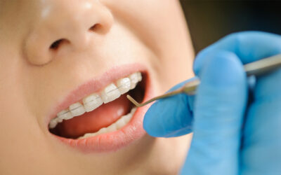Are Clear Braces As Effective As Traditional Metal Braces?