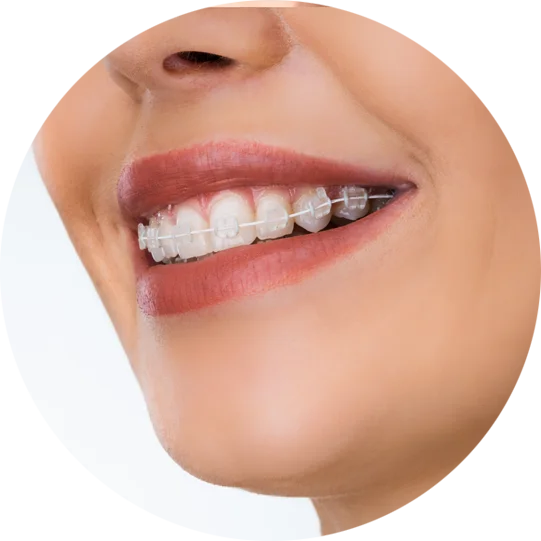 What are the Benefits of Clear Ceramic Braces?