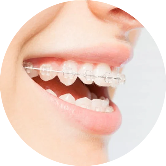 Clear vs Traditional Braces